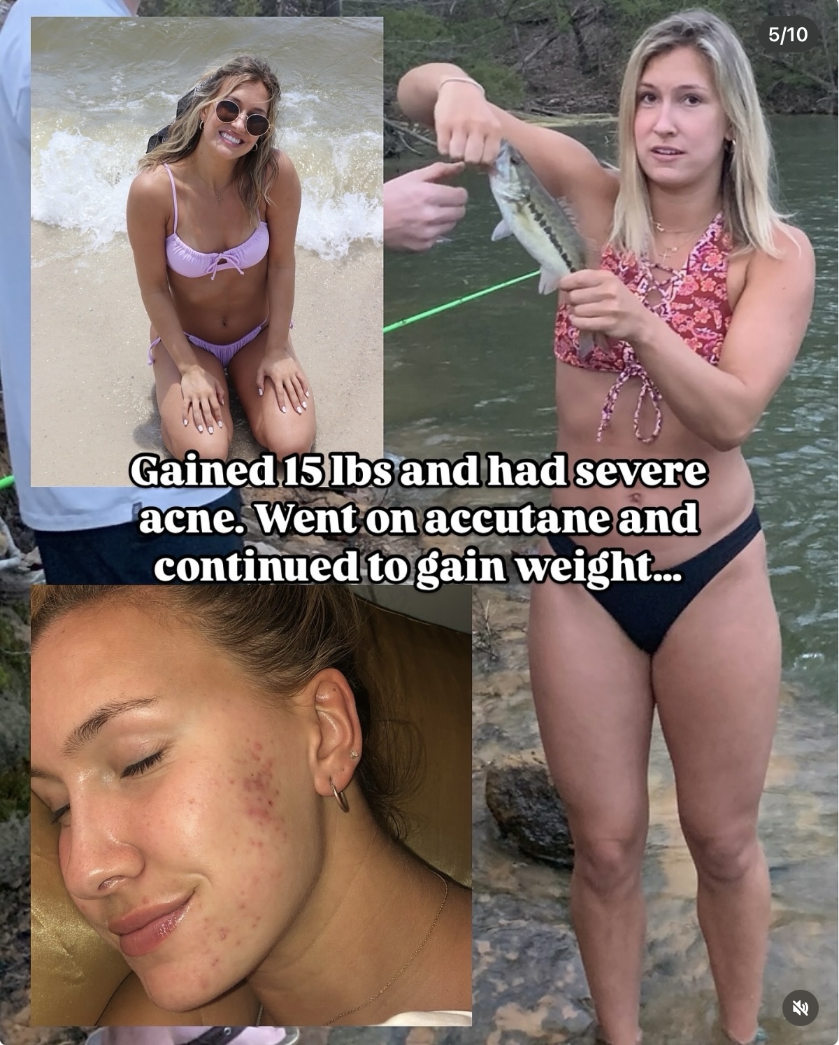 Chapter V — Gained 15 lbs. Severe acne.
